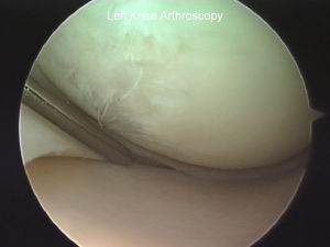 Partial thickness cartilage 